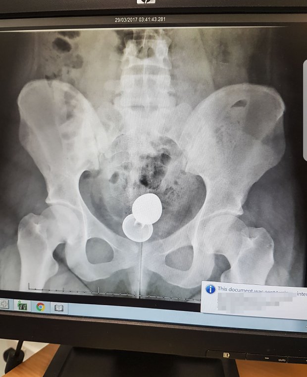 Sex toy pictured up her bottom on an x-ray